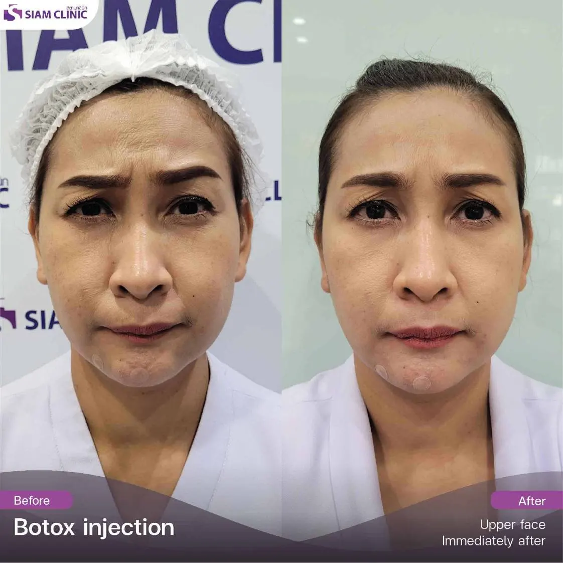 Wrinkle Botox treatment
