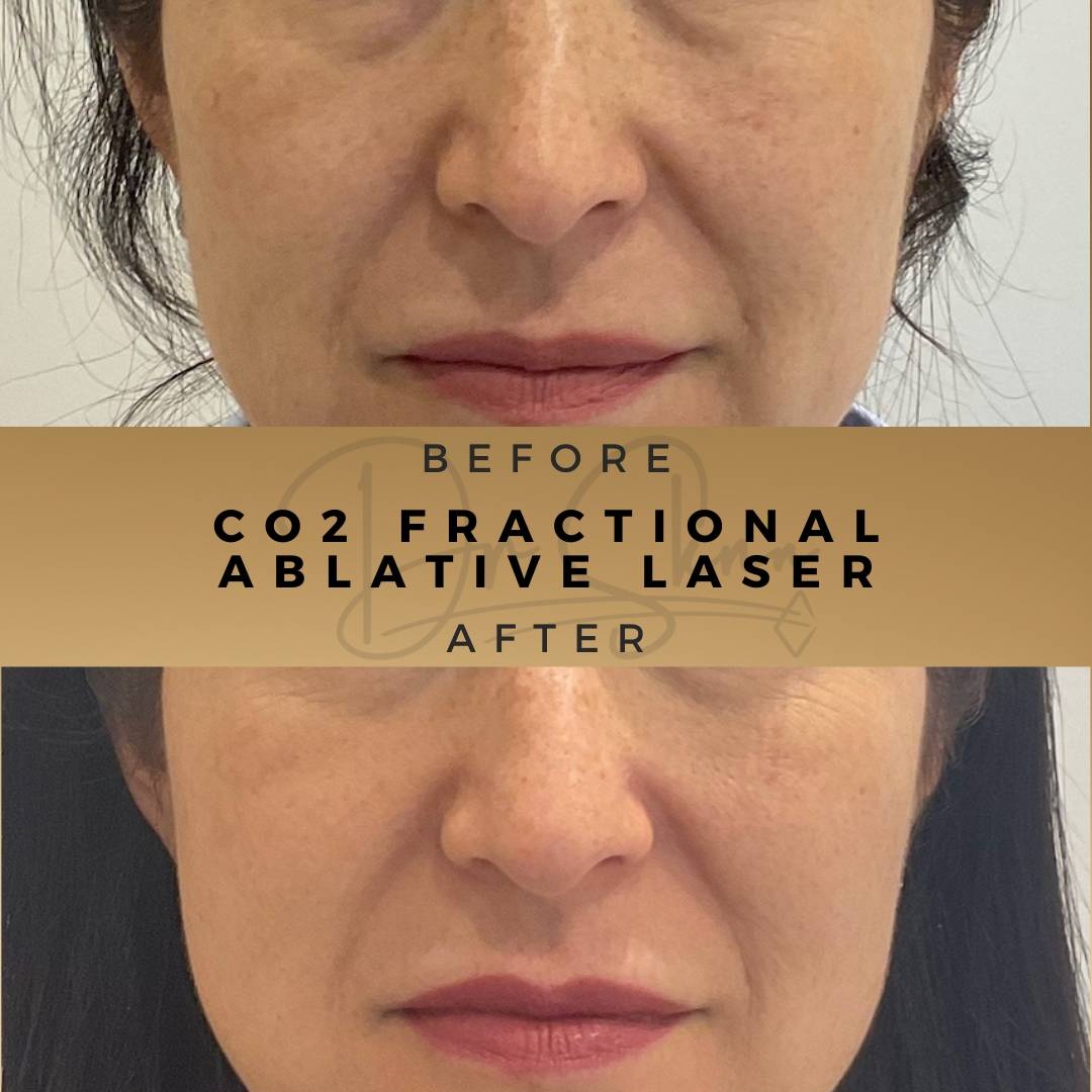 Skin Rejuvenation CO2 Fractional Ablative Laser Wilmslow Before & After Dr Sknn