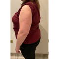 ONDA - NON-SURGICAL FAT REDUCTION, CELLULITE REDUCTION & SKIN TIGHTENING - before picture / Arm Fat Reduction