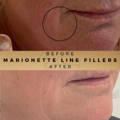 Marionette Line Filler Wilmslow Before & After Dr Sknn