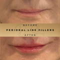 Perioral Line Fillers Wilmslow Before & After