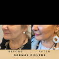 Cheek Fillers Wilmslow