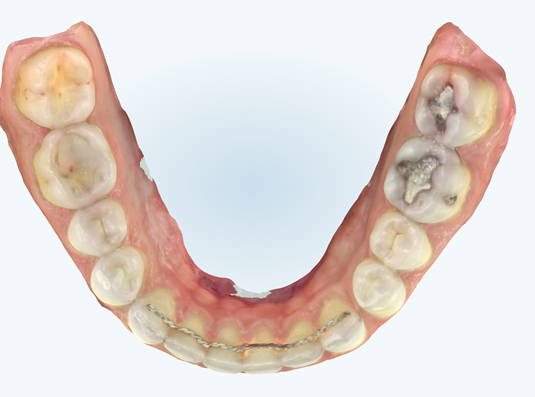 Scan of lower teeth