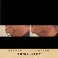 Jowl Fillers Wilmslow Dr Sknn Before & After Picture
