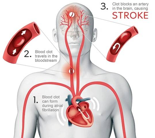 Blood clots caused by AFib