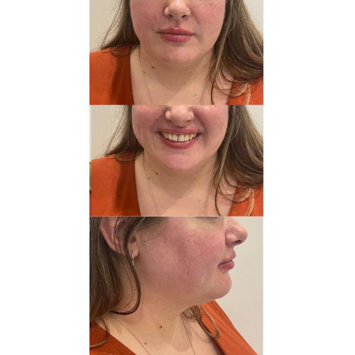 LIP FILLER WITH GUMMY SMILE CORRECTION AFTER