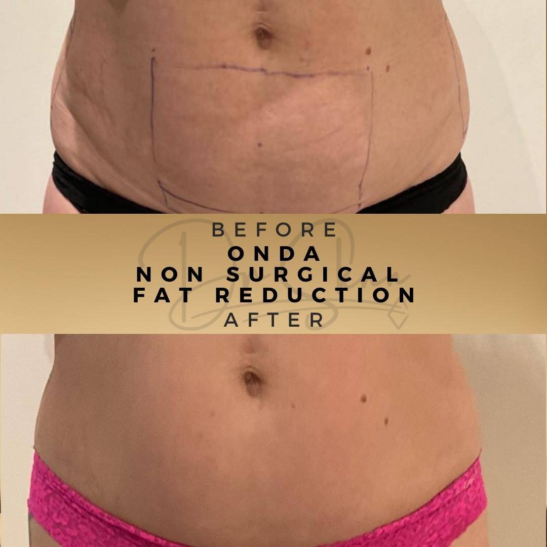 Non Surgical Fat Reduction Wilmslow Before & After Dr Sknn