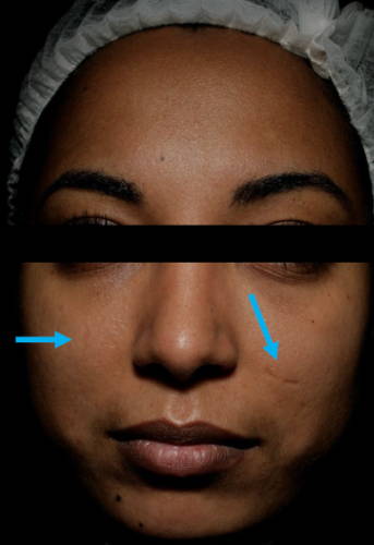 Dr Sknn Personalised Serum Microneedling - Custom Mesotherapy After