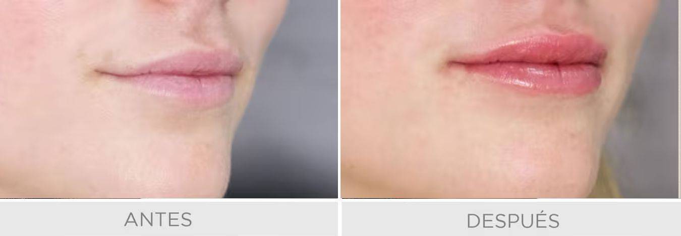 labios buenos aires romedical hialuronico