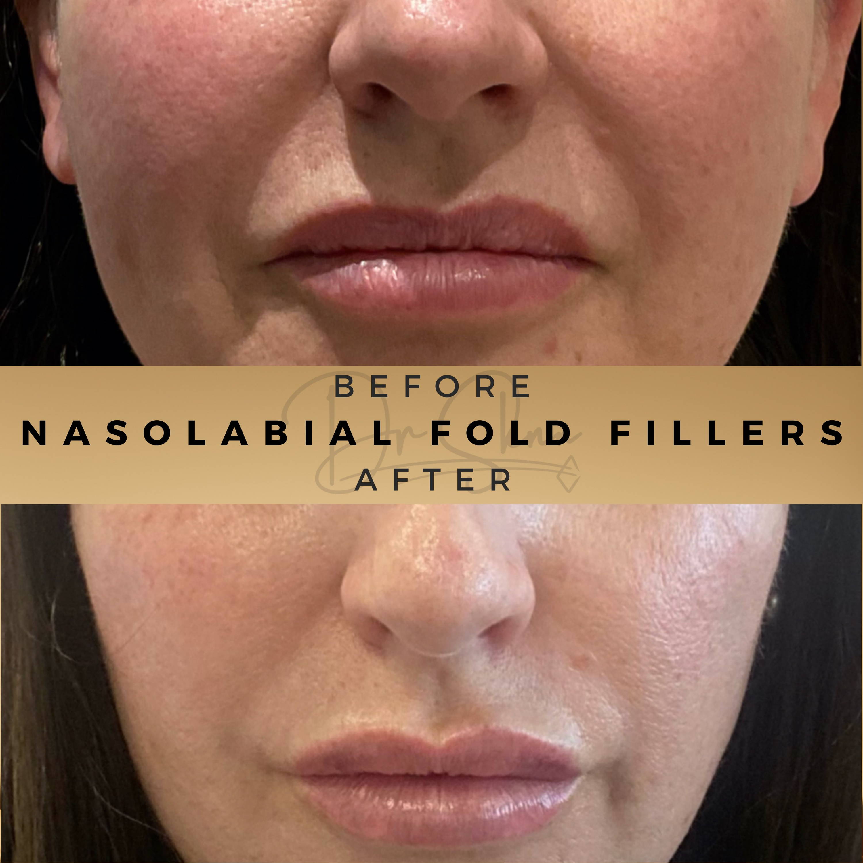 Nasolabial Fold Fillers Wilmslow Before & After Dr Sknn Wilmslow Before & After Dr Sknn