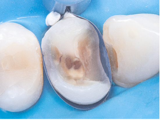 Tooth with decay exposed with DME band in place