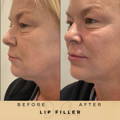 Perioral Line Fillers Wilmslow Before & After