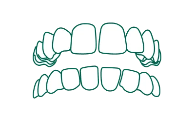 Gap Teeth
