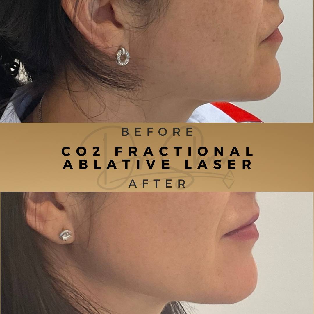 Skin Rejuvenation CO2 Fractional Ablative Laser Wilmslow Before & After Dr Sknn