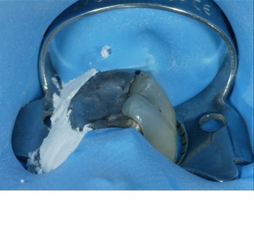 Compromised teeth or roots make an adequate seal difficult and rubber dams can still leak. OraSeal or OpalDam by Ultradent can effectively supplement the rubber dam by filling gaps or leaks easily.