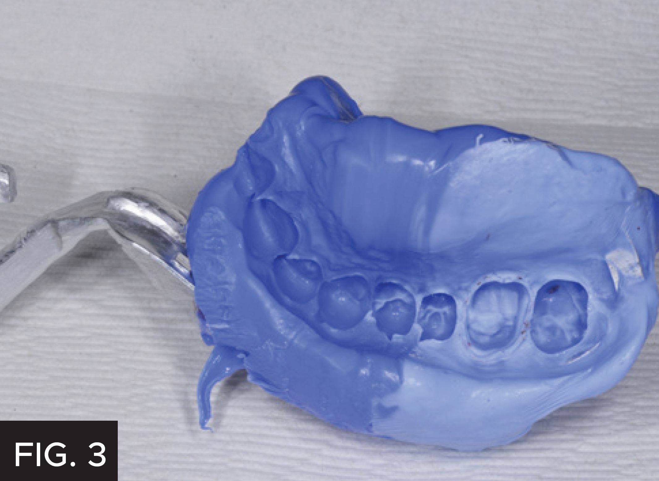 Affinity Light Body gets pushed subgingivally and adapts to the margin and cervical areas of adjacent teeth.