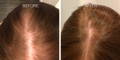 Nulastin-Scalp-Hair-Results-Before-After