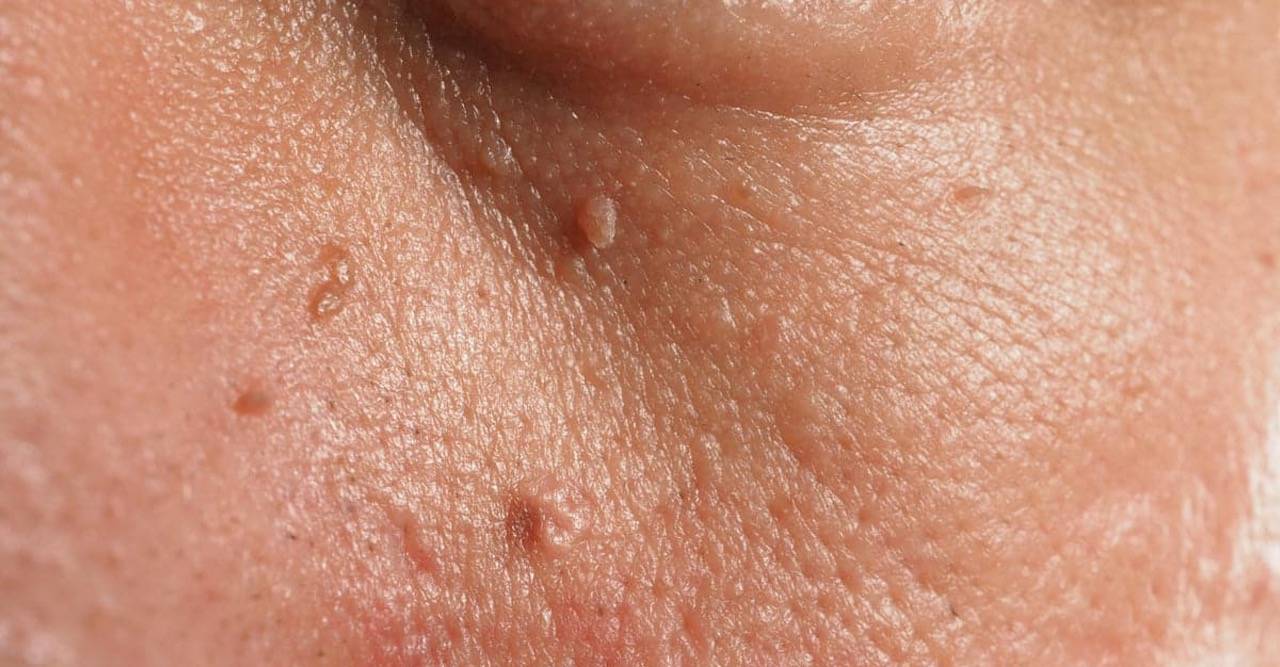 test feature imgae: Natural Methods Toolbox: Home Remedies to Remove Skin Tags