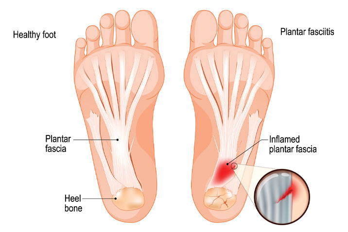 Plantar Fasciitis pain