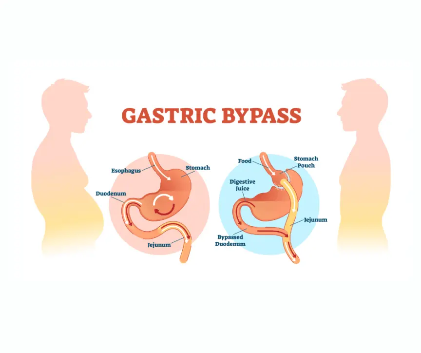 Gastric Bypass Bariatric Surgery & Weight loss in dubai