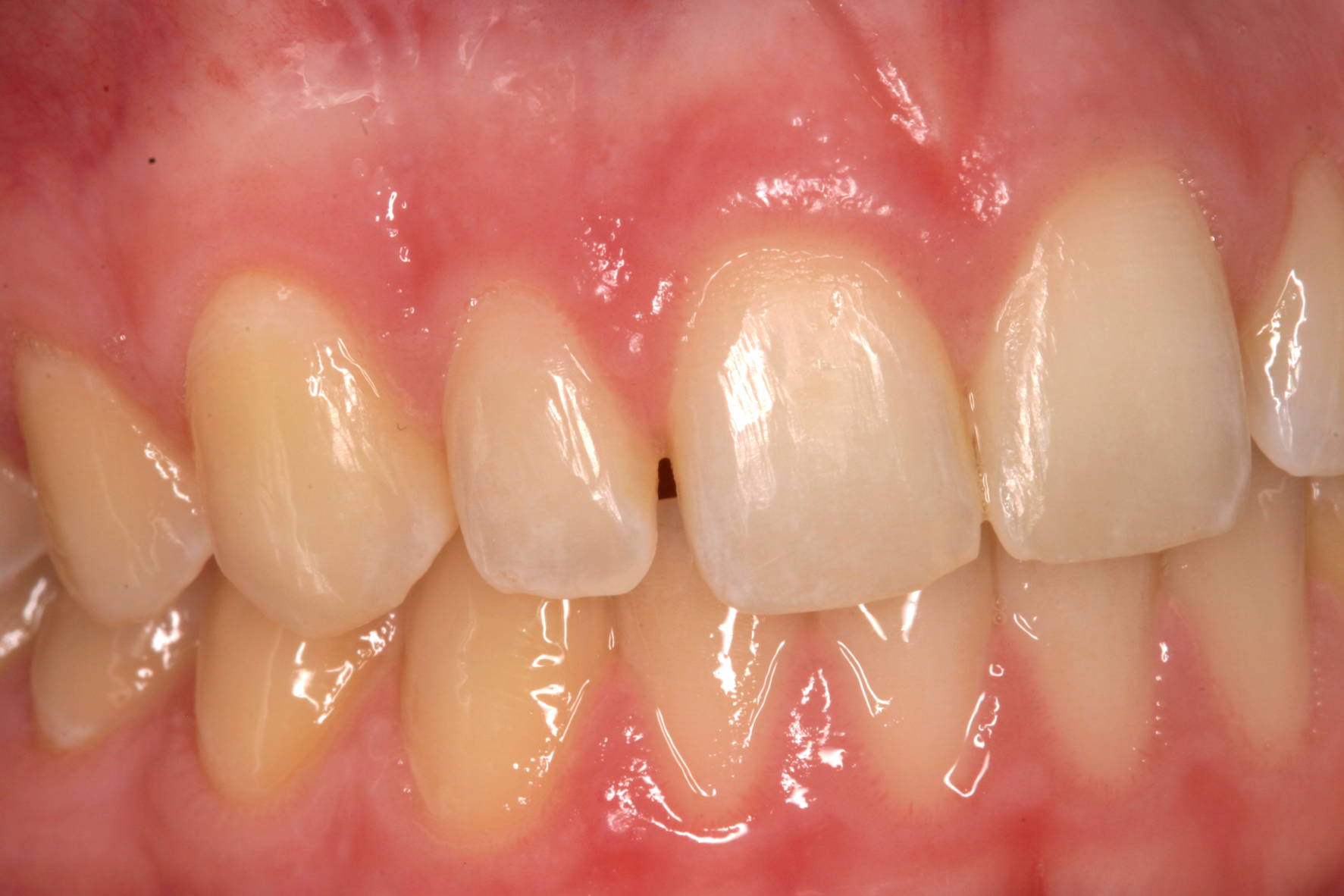 Pre-operative view showing upper peg lateral incisor