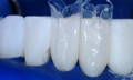 Bioclear Anterior Matrices and the injection molding technique