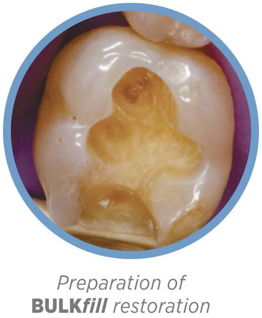 Posterior tooth being prepared to be restored