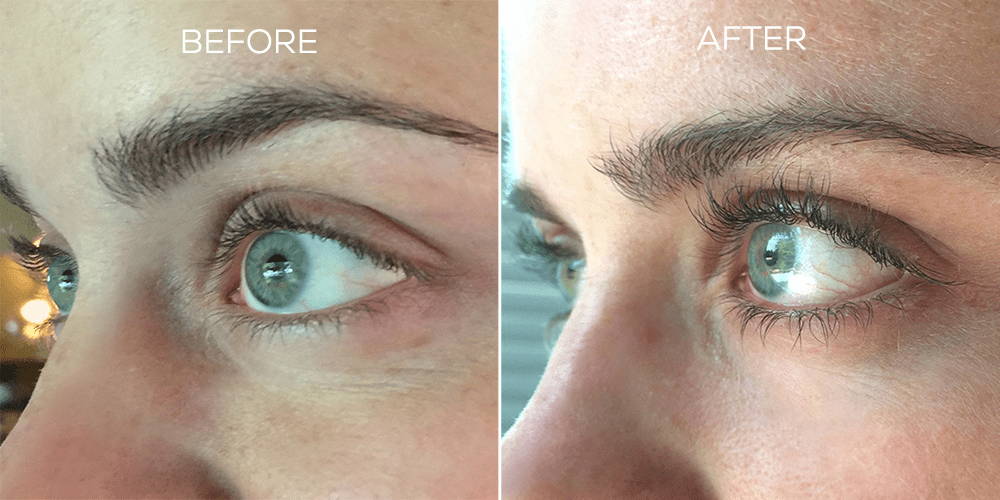 Before and After Results Using LASH Follicle Fortifying Serum with Keracyte® Elastin Complex