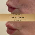 Lip Fillers Wilmslow with Anti-wrinkle injections