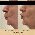 Lip Fillers Wilmslow with Anti-wrinkle injections
