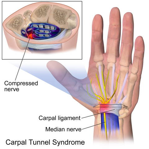 ergonomic carpal tunnel syndrome pain