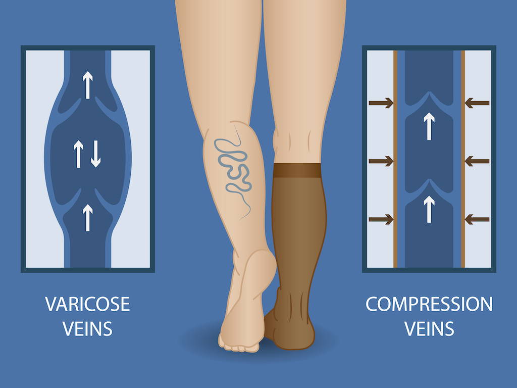 An illustration of Varicose veins and Compressed veins. Showing how compression socks help in the management of varicose veins.
