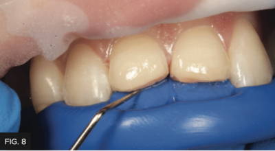 Lingual putty placed over prepared teeth