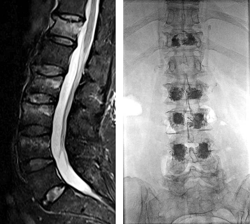 spine fracture image