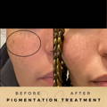 Before & After Pictures Dr Sknn Wilmslow Cheshire