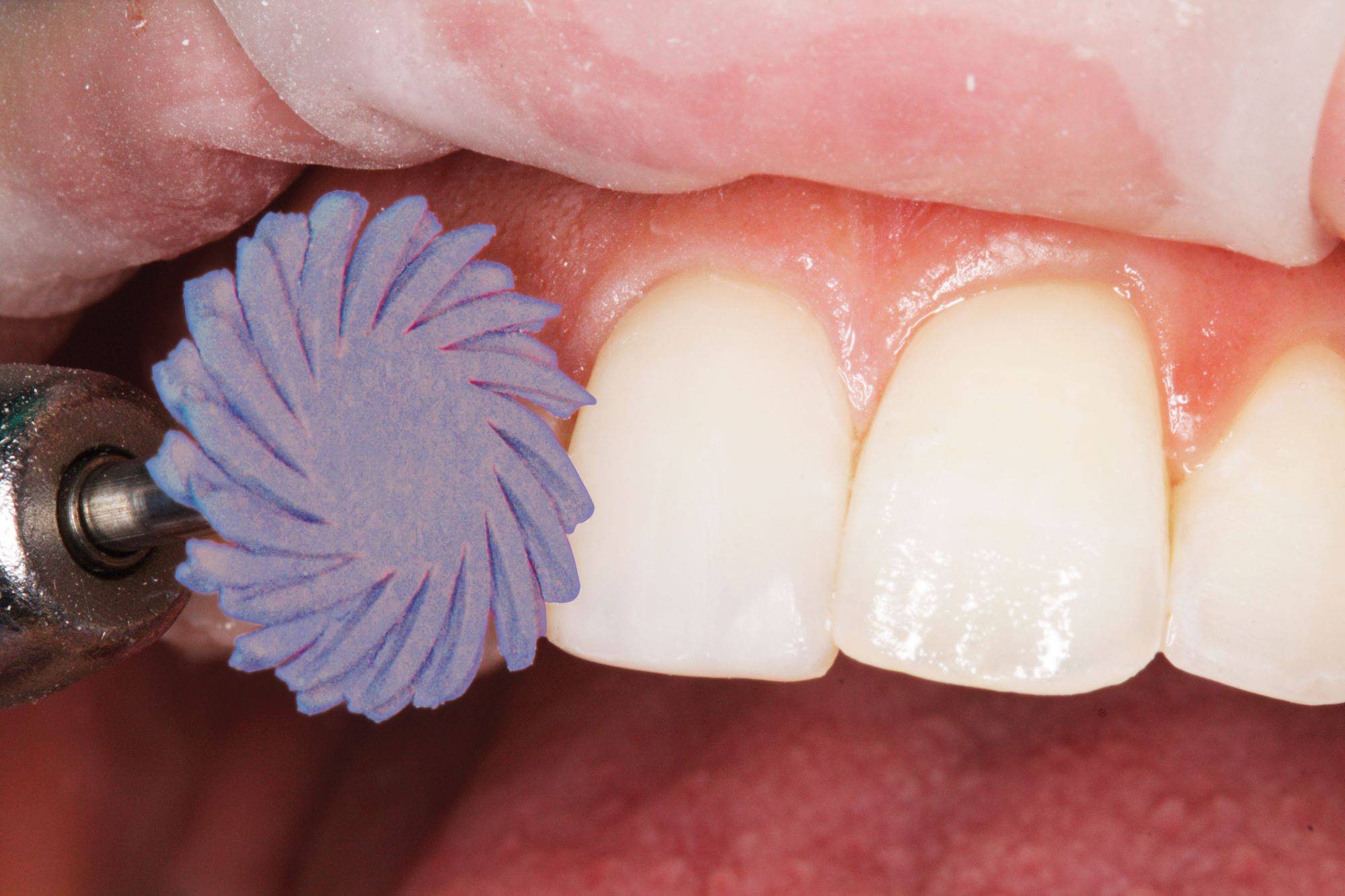 purple polisher touching upper incisor