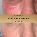 Redness Before & After Pictures Dr Sknn Wilmslow Cheshire