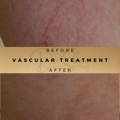 Before & After Pictures Dr Sknn Wilmslow Cheshire