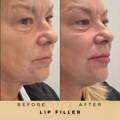 Perioral Line Fillers Wilmslow Before & After