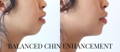 Balanced chin enhancement results by California Cosmetics