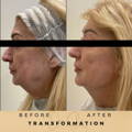 Jowl Fillers Wilmslow Dr Sknn Before & After Picture
