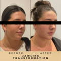 Mandibular Angle Fillers Dr Sknn Before & After Picture