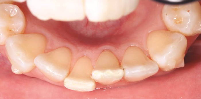 result after polishing and interproximal finishing