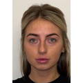NON SURGICAL FACE & NECK LIFT AFTER