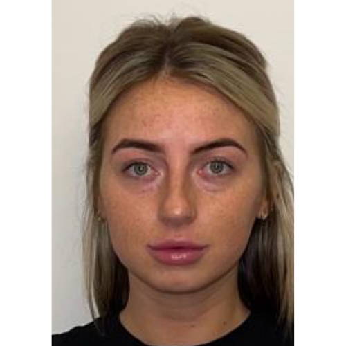 NON SURGICAL FACE & NECK LIFT AFTER