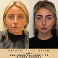 HIFU Wilmslow Non Surgical Facelift Wilmslow Dr Sknn Before & After Picture