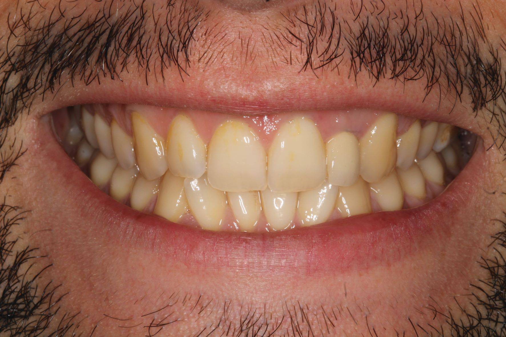 Pre-operative frontal smile of a male