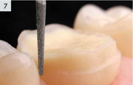 8858 diamond bur finishing the interproximal region of a tooth