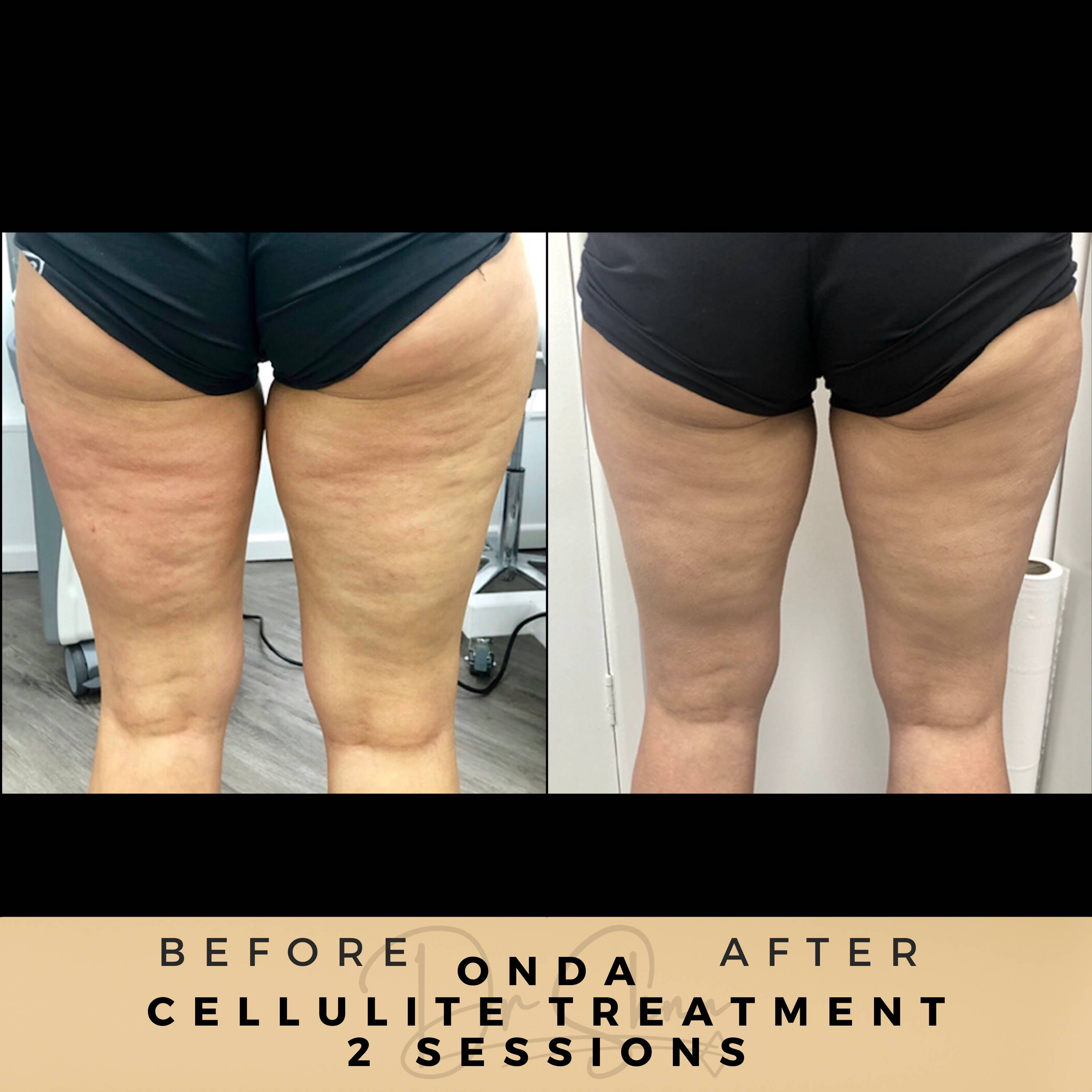 Cellulite Removal - Non-surgical - Dr Sknn before and after