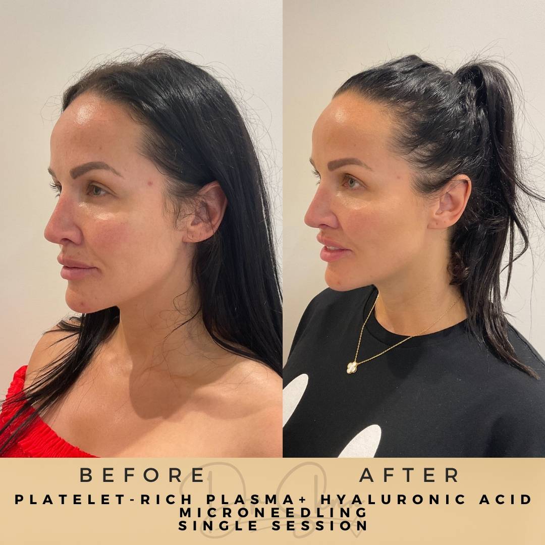 PRP Microneedling - Dr Sknn before and after